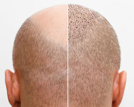 FUE Hair Transplant